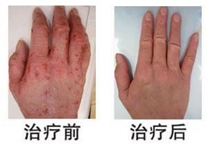 东莞湿疹治疗与预防,十佳名院,广州皮肤病研治中心