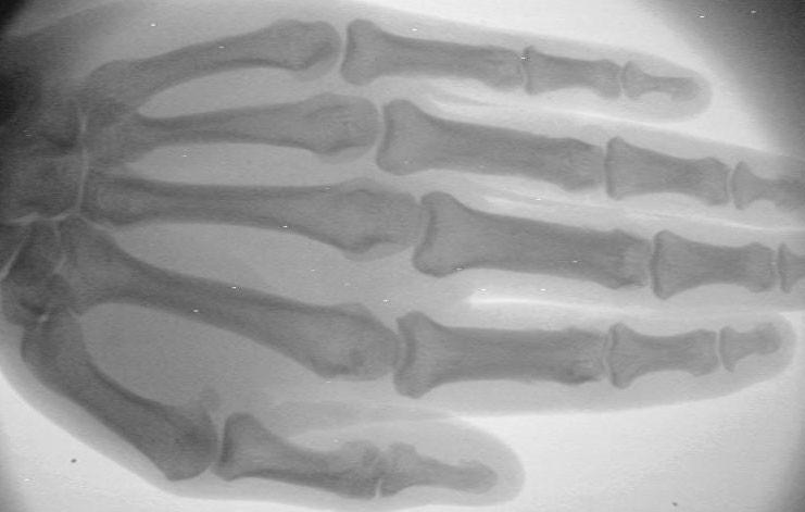 供应骨龄骨密度医用X光机